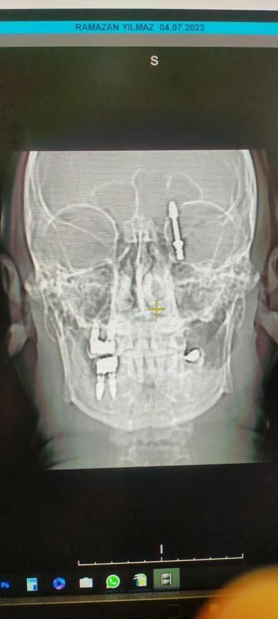 Diş implantı, çene kemiği ile orbita tabanını delip, beyin omurilik sıvısına girdi