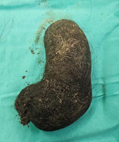 9 yaşındaki çocuğun midesinden saç yumağı çıktı