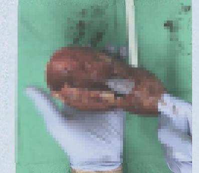 Yıllarca ameliyattan kaçtı, ölümden cerrahın parmakları ile kurtuldu