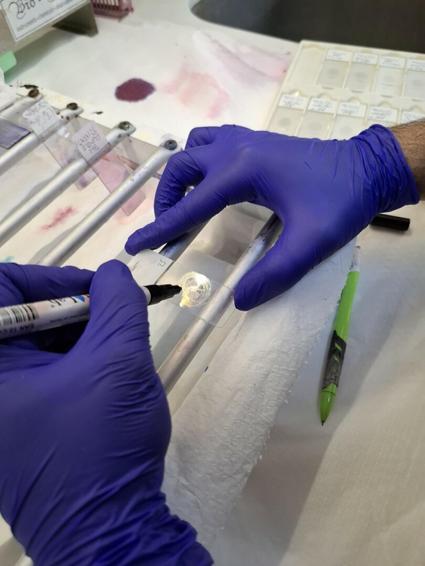 Egenin tek kas ve sinir biyopsisi yapılan hastanesiyiz