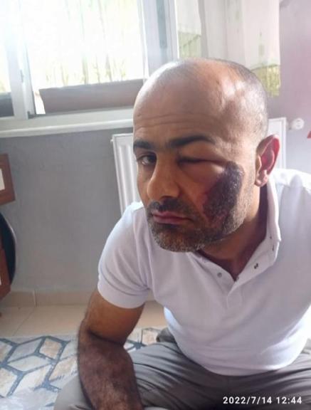 Lazer epilasyon sonrası yanık suçlaması