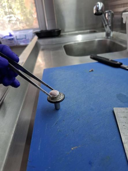 Egenin tek kas ve sinir biyopsisi yapılan hastanesiyiz