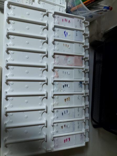 Egenin tek kas ve sinir biyopsisi yapılan hastanesiyiz