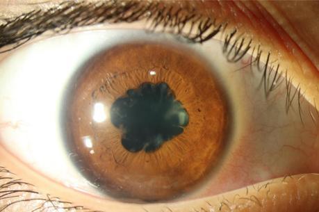 Üveit’te geç muayene kalıcı görme kaybına neden olabilir