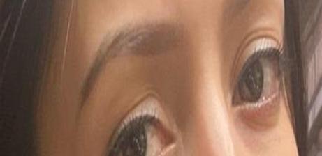 Güzellik salonundaki işlem sonrası gözünde hasar iddiasıyla yaptığı şikayet reddedildi; Uzmanına gidin uyarısı yaptı