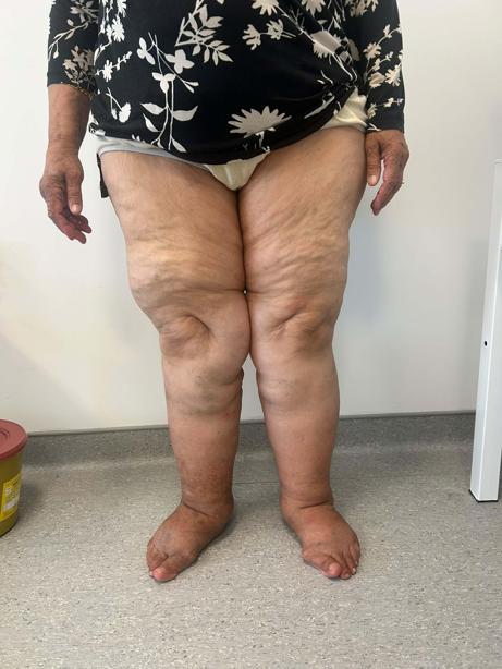 Bacaklardaki simetrik ağrı ve morarma, lipodemin işareti olabilir