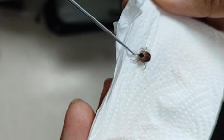 Çocuğun kulağından canlı kene çıkarıldı