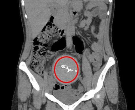 Doğumda unutulduğu 2 yıl sonra ortaya çıkan gazlı bez ihmaline soruşturma izni