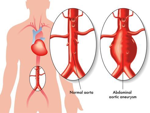 Aort anevrizması ciddi komplikasyonlara yol açmadan önce belirti vermeyebiliyor