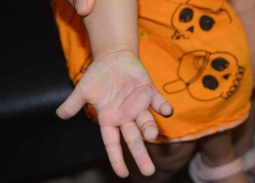 Yanlış teşhis nedeniyle parmağında his kaybı oluşan Elizin ailesi hukuk mücadelesi başlattı