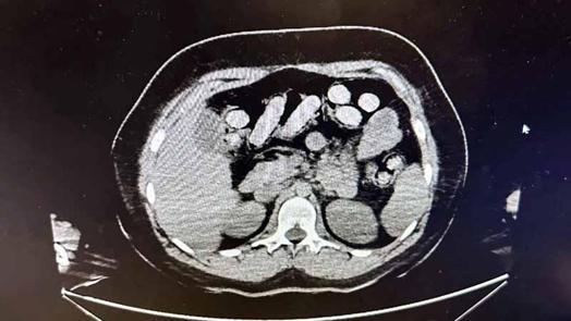 Midesinde 1,5 kilo metamfetaminle yakalanan 2 kadın kurye tutuklandı