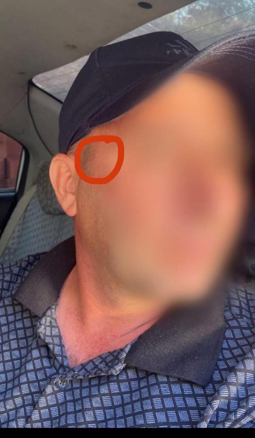 Uyuşturucu şüphelisi, yakalanmamak için şakağındaki beni aldırmış