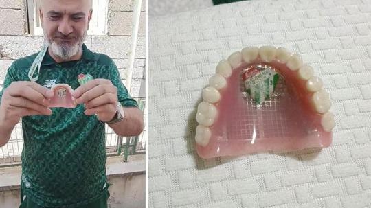 Bursaspor’un fanatik taraftarı takma dişinin damağına da kulüp amblemi yaptırdı