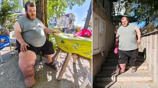 Fil hastası Kazım'ın tedavi olabilmesi için 82 kilo vermesi gerekiyor
