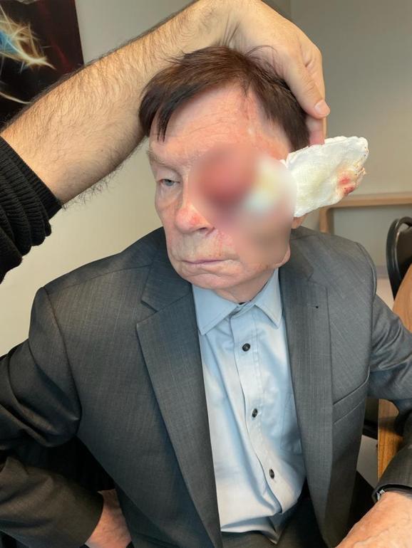 15 gün yaşamaz’ denilen Rus hastanın yüzünden 2 yumruk büyüklüğünde tümör çıktı