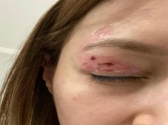 Güzellik salonundaki işlem sonrası gözünde hasar iddiasıyla yaptığı şikayet reddedildi; Uzmanına gidin uyarısı yaptı