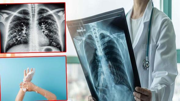 'Kışın solunum yolu enfeksiyonlarında artış doğal, hijyen şart'