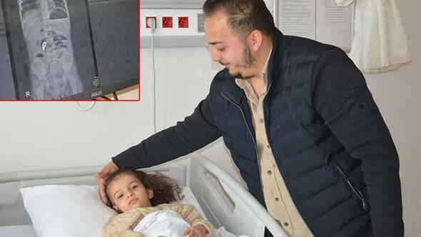 4 yaşındaki Eda’nın bağırsağından 8 adet mıknatıslı boncuk çıkarıldı