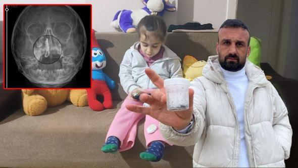 5 yaşındaki Polen, 2 yıldır burnunda tırnak makası zinciriyle yaşamış