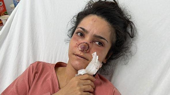 Eşi tarafından burnu ısırılıp koparılan İmran: Canımın acıyla balkondan atlamayı bile düşündüm