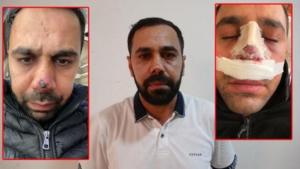 Ameliyat sonrası burnunda iz oluştuğunu iddia edip, tedavi masrafı için hastaneye dava açtı