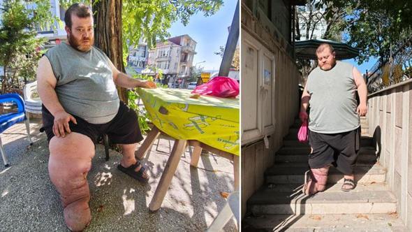 Fil hastası Kazım'ın tedavi olabilmesi için 82 kilo vermesi gerekiyor