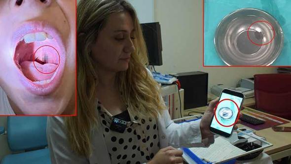 Siirt'te 10 yaşındaki çocuğun boğazından canlı sülük çıktı