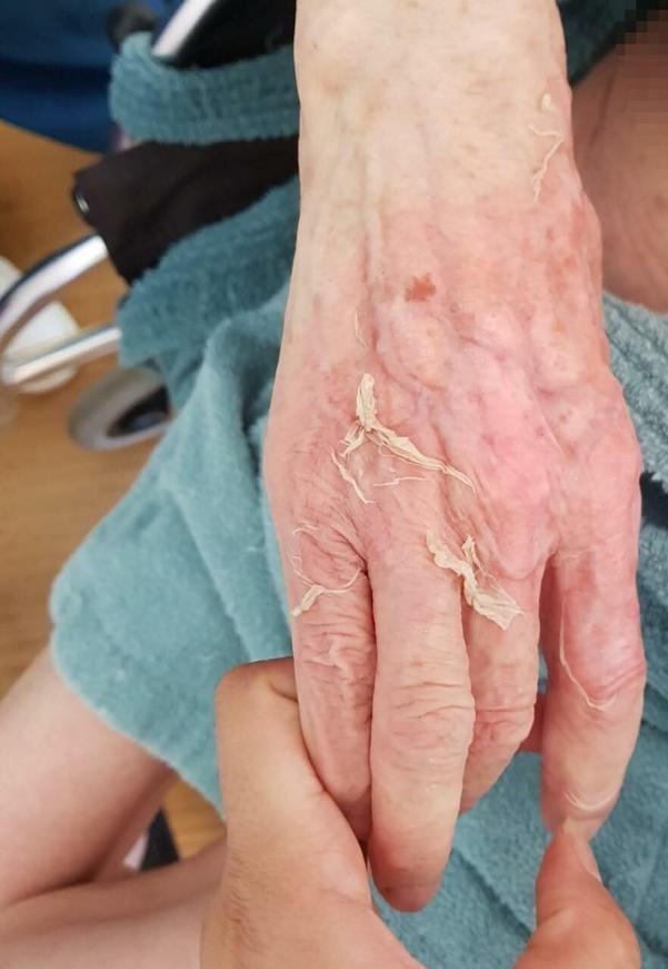 Huzurevindeki ölümde beklenen rapor geldi: Dermatolojik hastalık tespit edilmedi