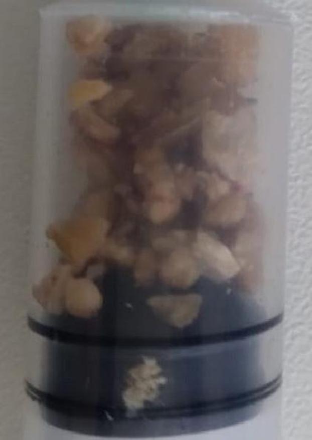 14 aylık Göktürkün böbreğinden 40 taş çıkarıldı