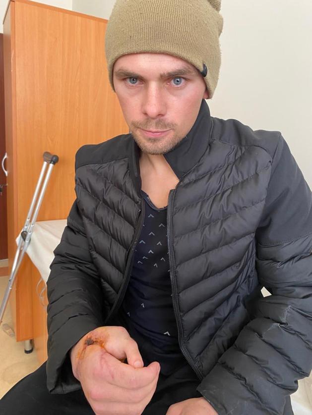 Kopan el parmağı yerine ayak parmağı dikildi