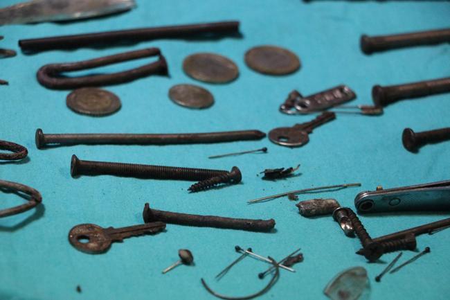 Nails, knives, tweezers: 158 pieces of metal were removed from the stomach of a woman