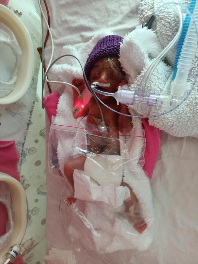 710 gram doğan Arden bebek, hayata tutundu