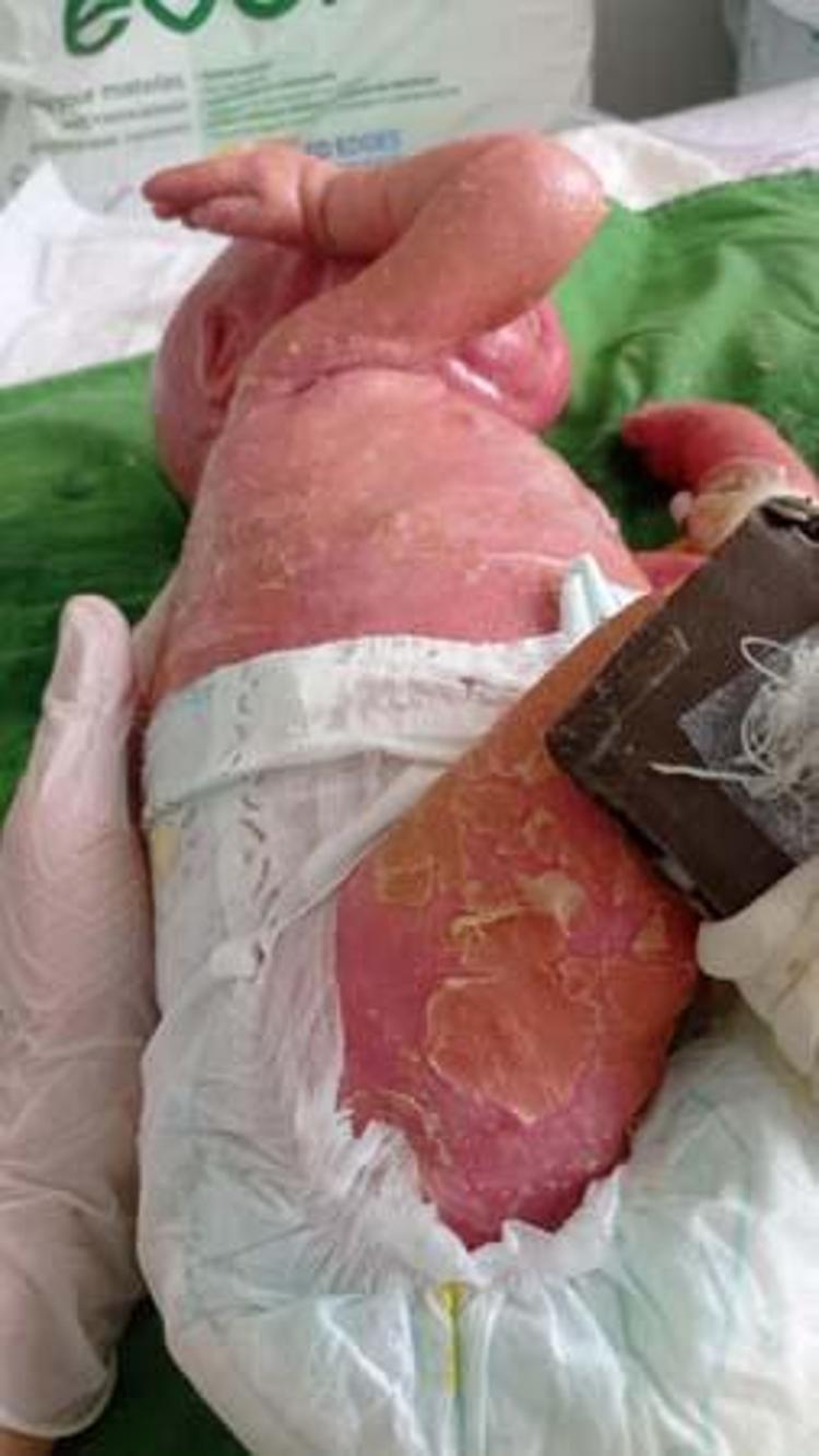 300 MİLYONDA BİR GÖRÜLEN NADİR HASTALIK