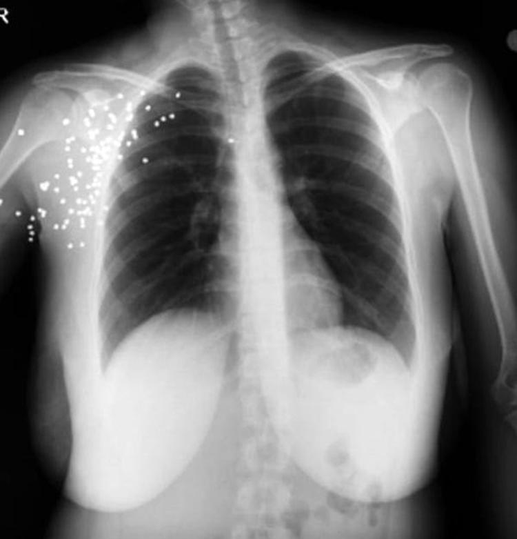 TAM 5 KEZ AMELİYAT OLDU