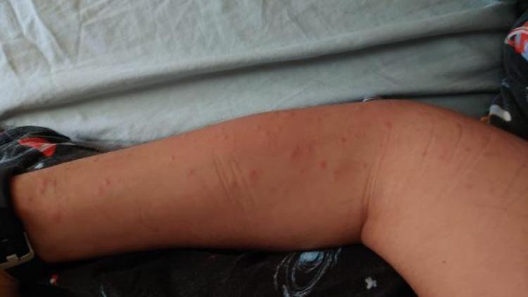 ÖNCE HIV TEŞHİSİ ALDI SONRA KOVİD OLDU EN KÖTÜSÜ BUYDU DEDİ