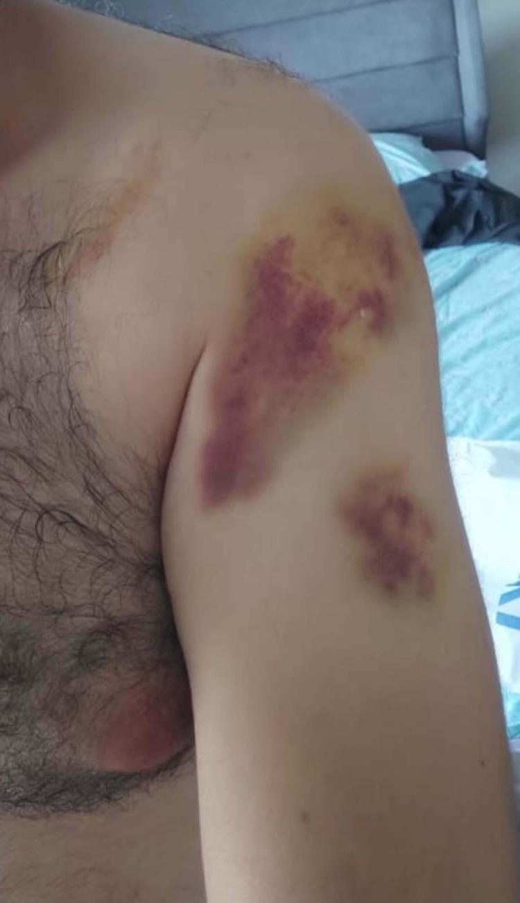 EŞİMİN BURNUNDA ÇATLAK, OĞLUMUN KALÇASINDA MORLUK VAR