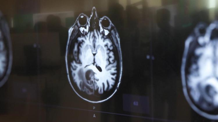 FARKLI TİPTEKİ ANEVRİZMALARIN GENETİĞİ DE ÇÖZÜLECEK