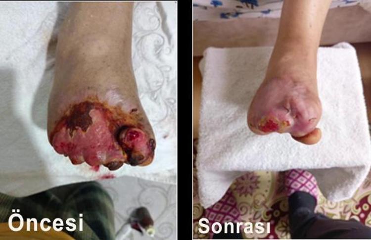 ŞEKER HASTALARI İYİLEŞTİRİLDİ