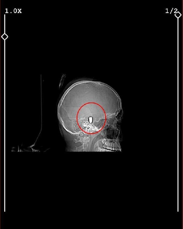 4 GÜN GÖZÜMÜ AÇAMADIM