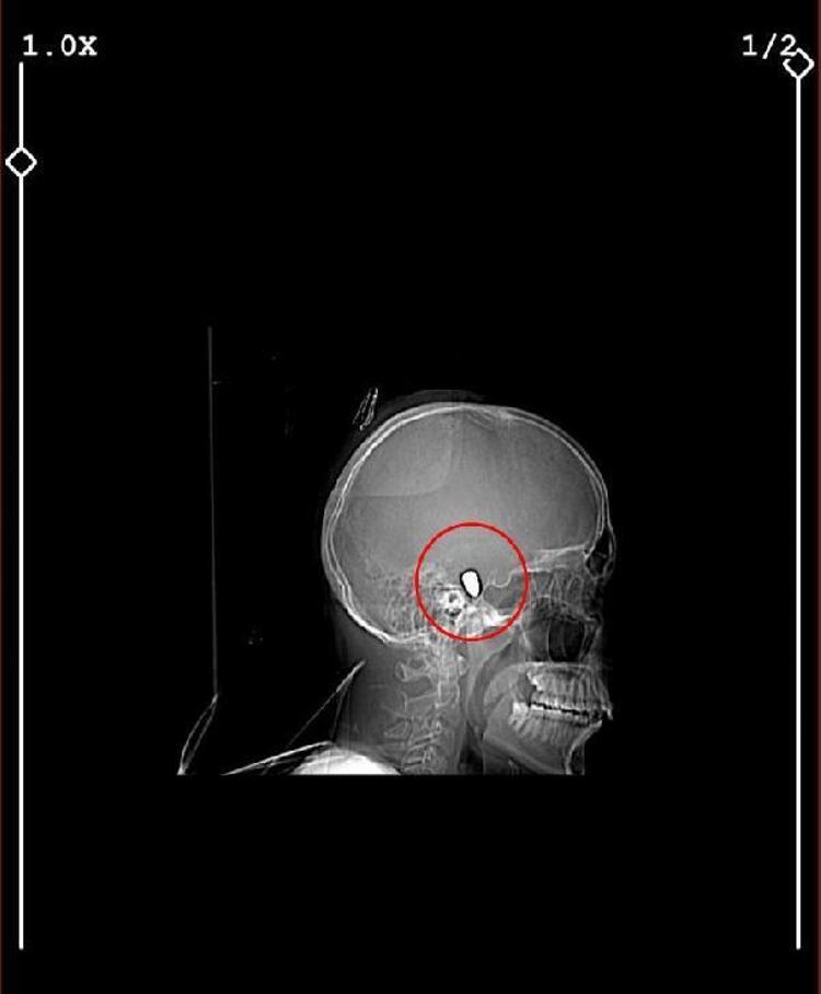 O GÜNDEN BERİ YÜRÜYEMİYORUM