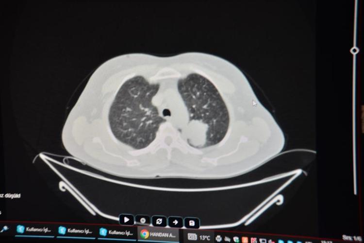 KADINLARIN SİGARA İÇME ALIŞKANLIĞI DEĞİŞTİ; KANSER SIKLIĞI ARTTI