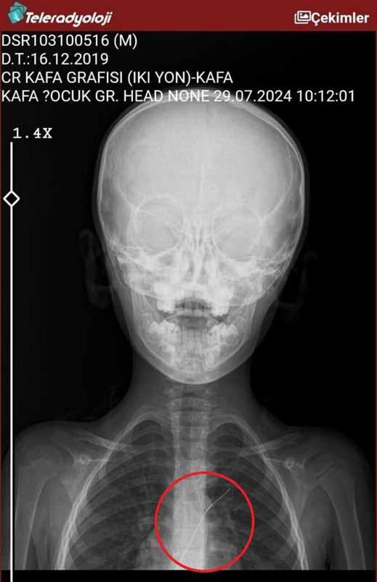 ‘ÇOCUĞUM YAKLAŞIK 5,5 SAAT AMELİYATTA KALDI’