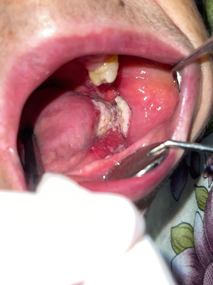 AĞIZ KANSERİ BULAŞICI DEĞİL