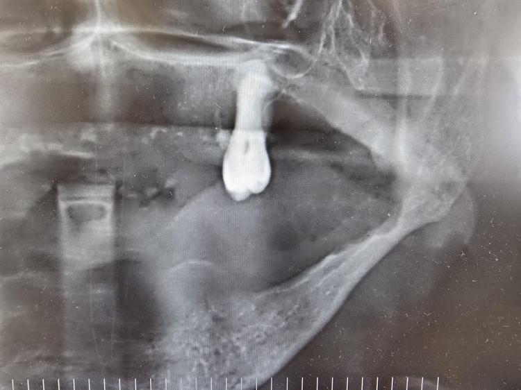 KANSERE YAKALANMAMAK İÇİN TÜTÜN VE ALKOLDEN UZAK DURULMALI