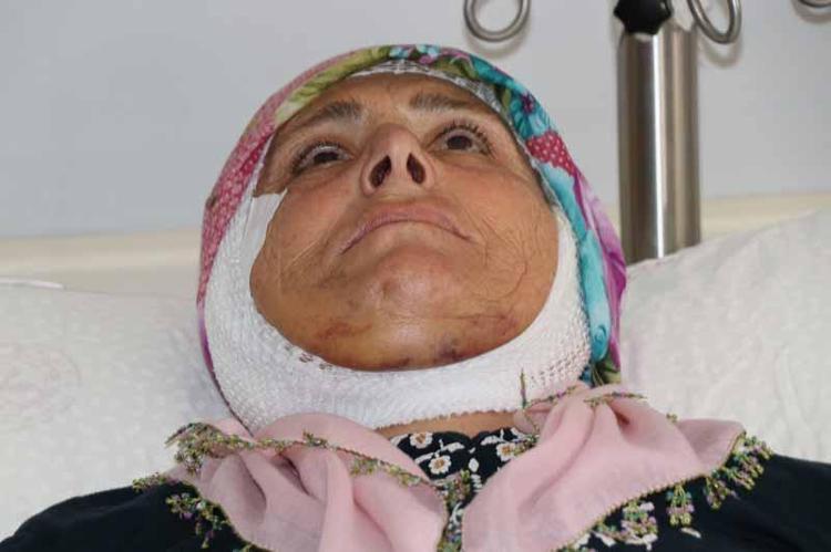 YÜZ FELCİ HASTALAR, CERRAHİ YÖNTEMLE VEYA İLAÇ TEDAVİSİ İLE DÜZELEBİLİYOR