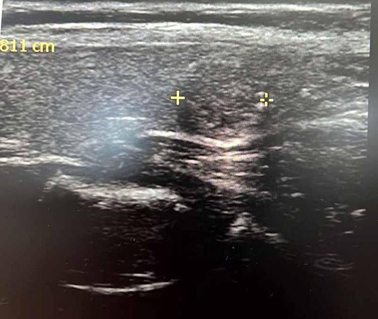 YAŞ İLERLEDİKÇE TİROİT NODÜLÜ SIKLIĞI ARTIYOR