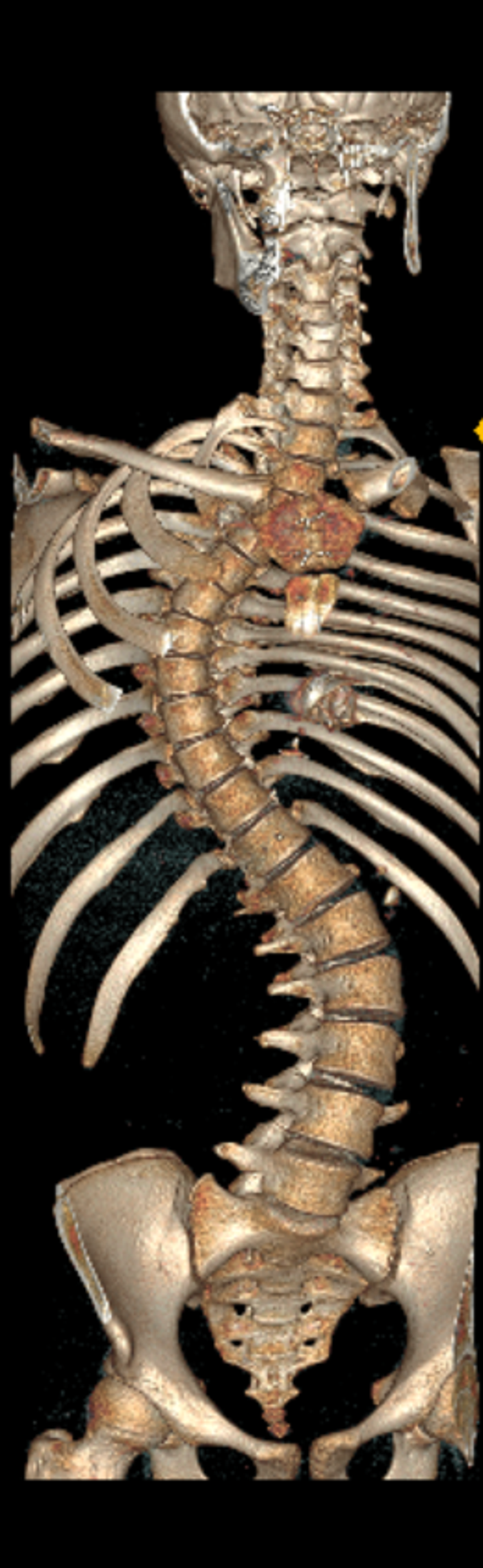 İKİ AŞAMADA OPERASYONU TAMAMLADIK