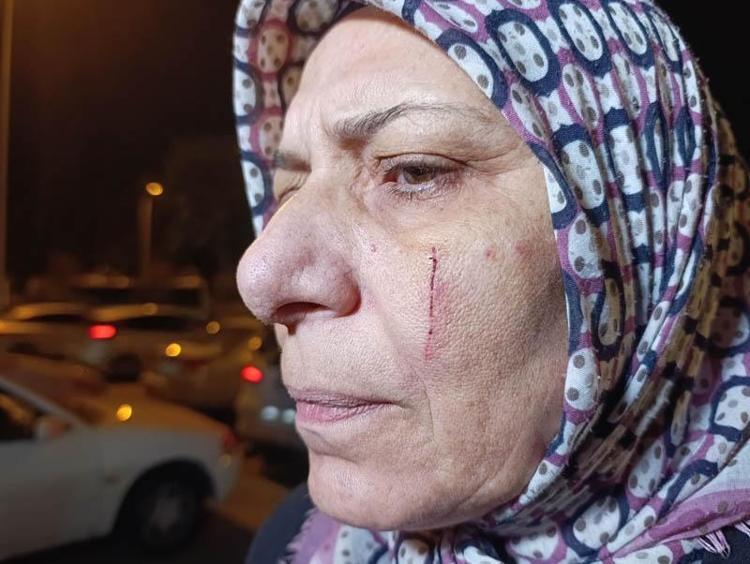 YÜZÜMÜ BIÇAKLA YARALADI