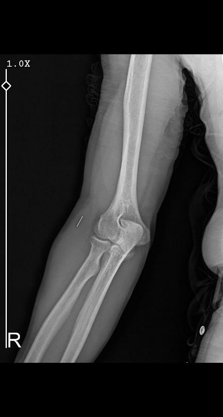 1 SANTİMETRE METAL PARÇA TESPİT EDİLDİ