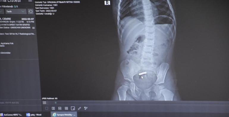 Cemrenin bağırsaklarından 5 tane mıknatıslı bilye çıktı